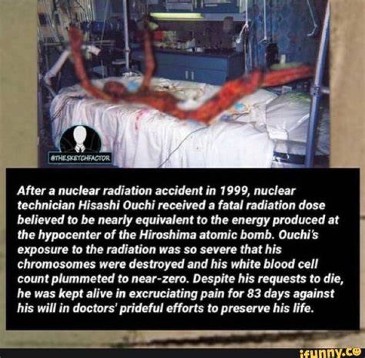RIP: Hisashi Ouchi Corpse Photos, Man Suffered Nuclear And Radiation Accident